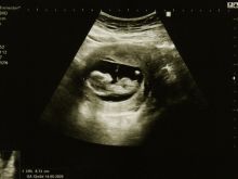 Ultrasound of preborn baby at 12 weeks
